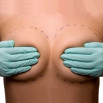 Маммопластика - эстетическая хирургия