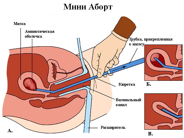 Об аборте и его последствиях Можно ли идти к.